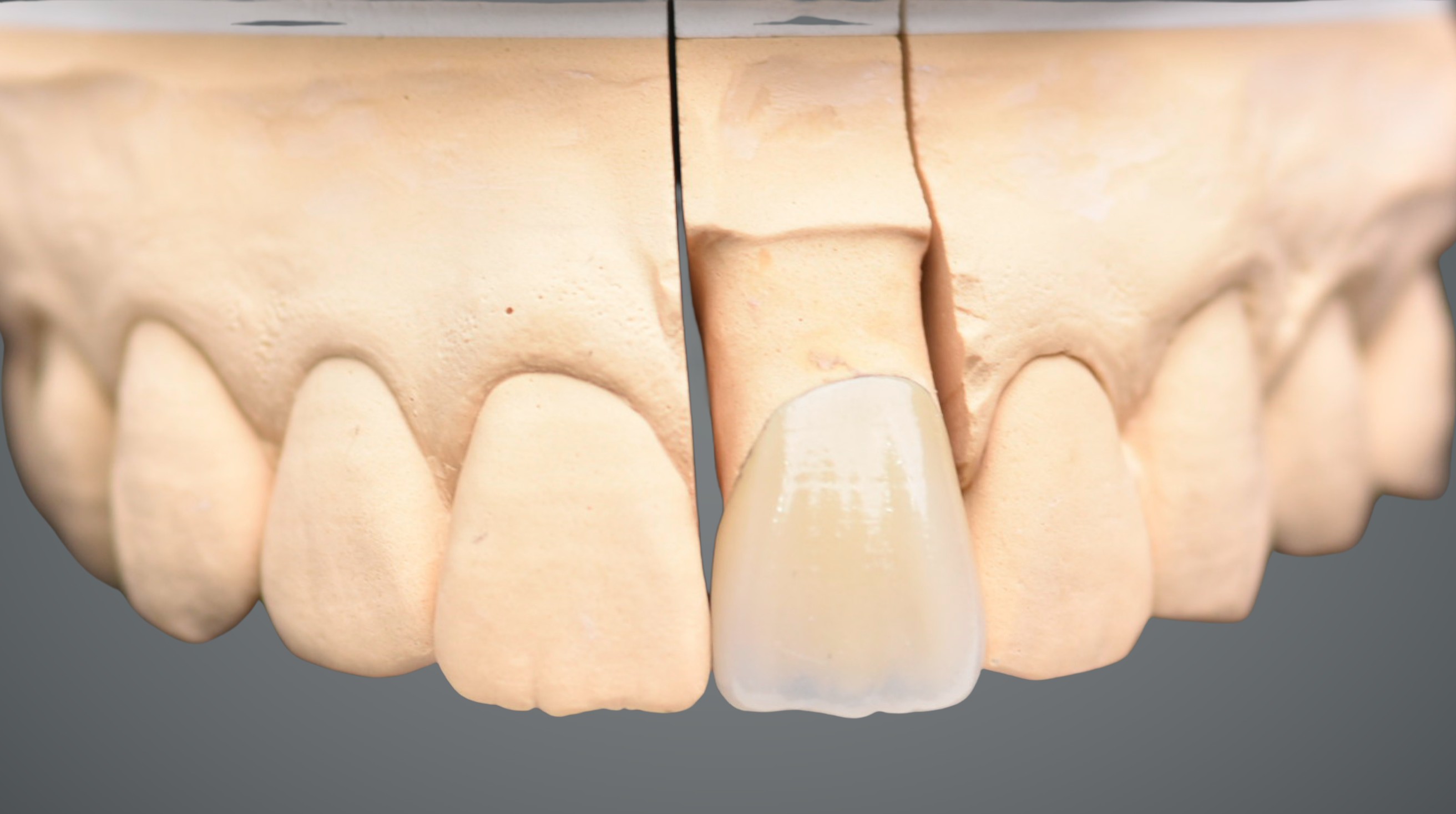 Aesthetic Zirconia