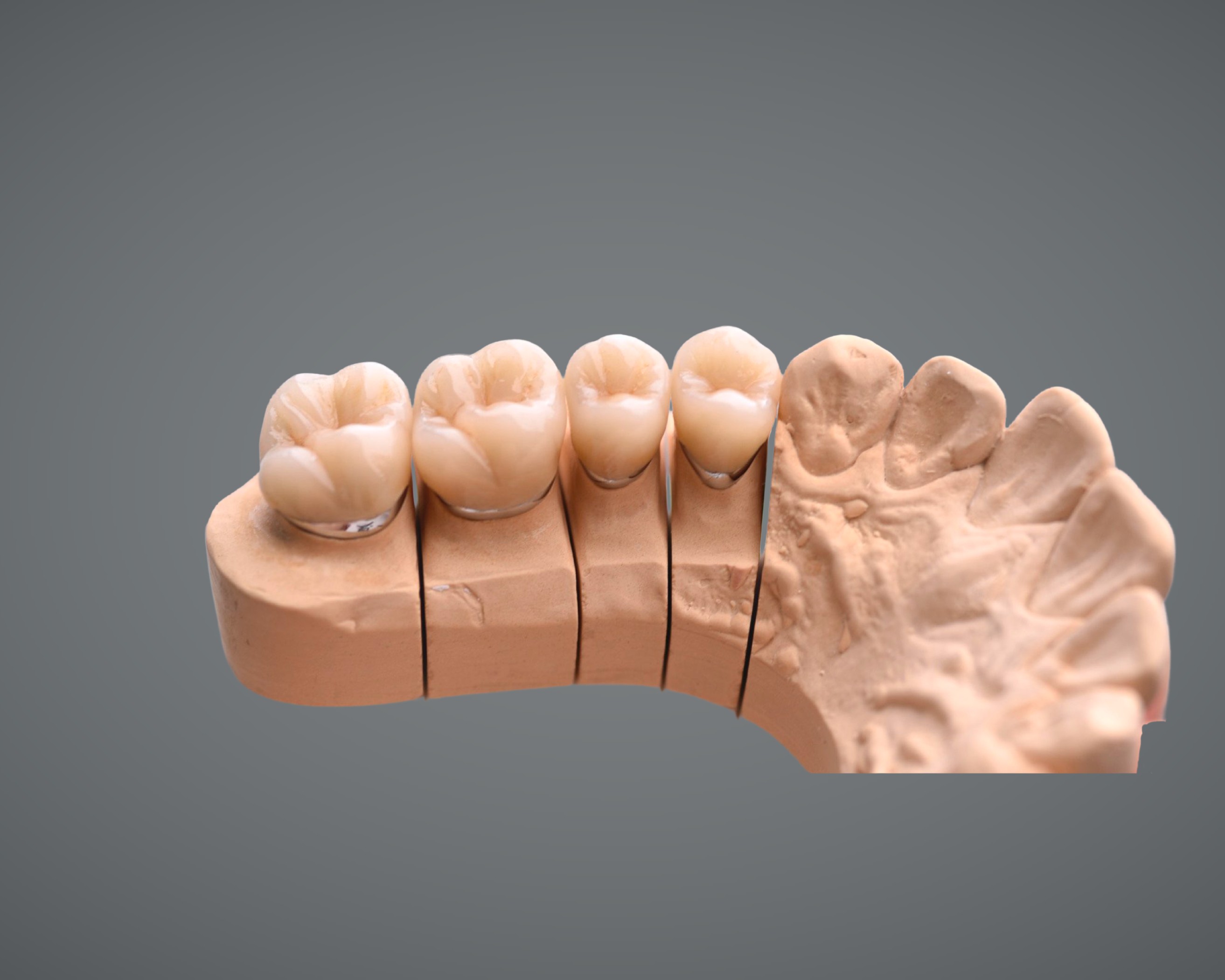 PFM (Porcelain Fused to Metal)