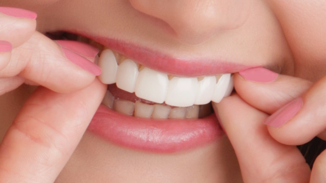 Pearl Snap-in Smiles / Mock-up Veneers
